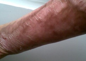 10多年的烫伤疤痕能否治疗呢？ 