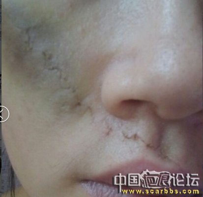 脸颊8cm25年凹陷疤痕9月17号在九院武医生那里做了切除 