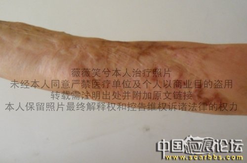 我的烧伤疤痕15次扩张器手术图片记录 大量治疗效果对比照片 疤痕,手术室,手术,治疗,中国