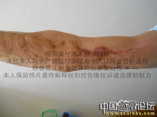 我的烧伤疤痕15次扩张器手术图片记录 大量治疗效果对比照片 疤痕,手术室,手术,治疗,中国