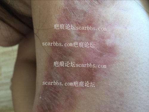 肩膀疤痕增生，上海第六人民医院注射平复后锶90治疗持续更新中。。。 