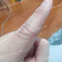 手指关节疤痕