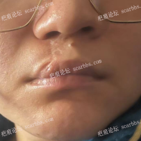 唇裂二次修复后白唇疤痕如何治疗