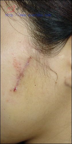 [分享]我治疗的疤痕手术切除对比图例 