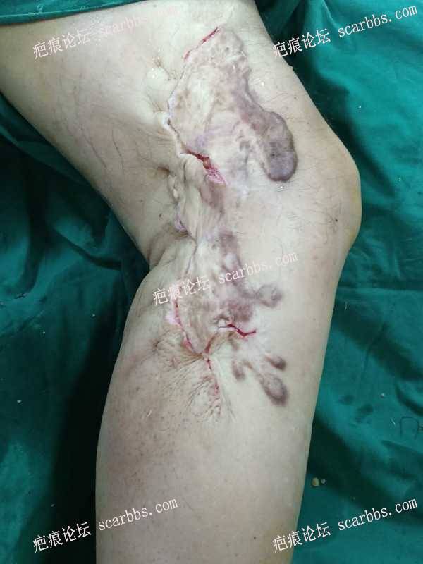 蔡氏肿胀局麻分级减张缝合技术手术中不出血，一次切除大面积疤痕不植皮 