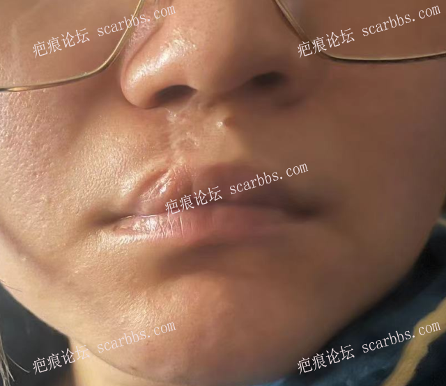 唇裂二次修复后白唇疤痕如何治疗