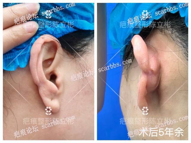 耳部疤痕疙瘩患者术后5年反馈 