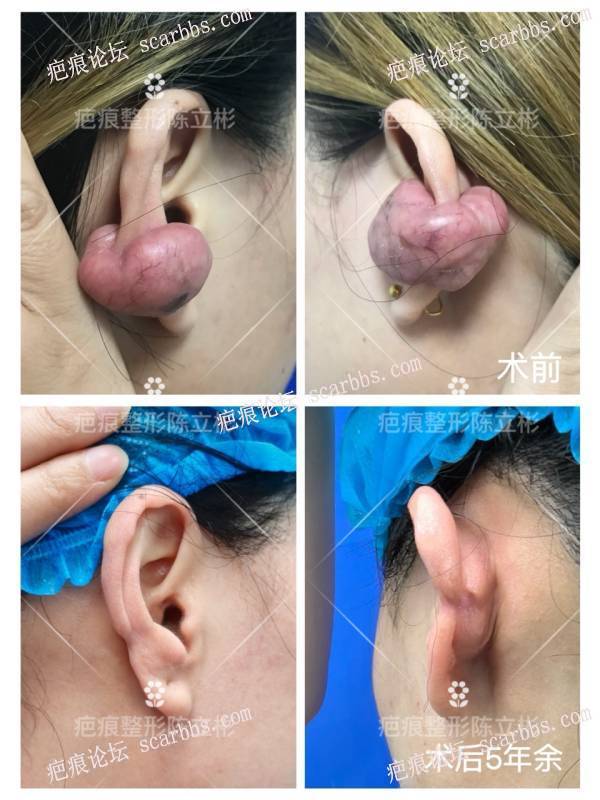 耳部疤痕疙瘩患者术后5年反馈 