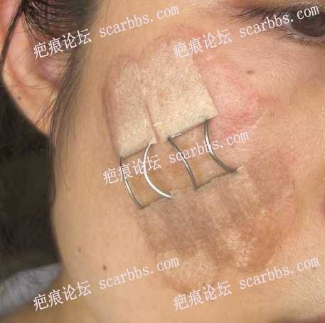3月25日杨教授面部额头疤痕修复 