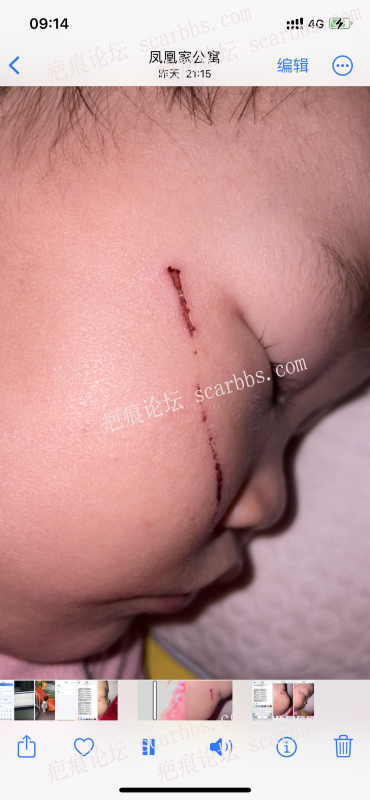 求助，小孩一岁半，被指甲划伤两个月了留有红色凹陷疤痕 