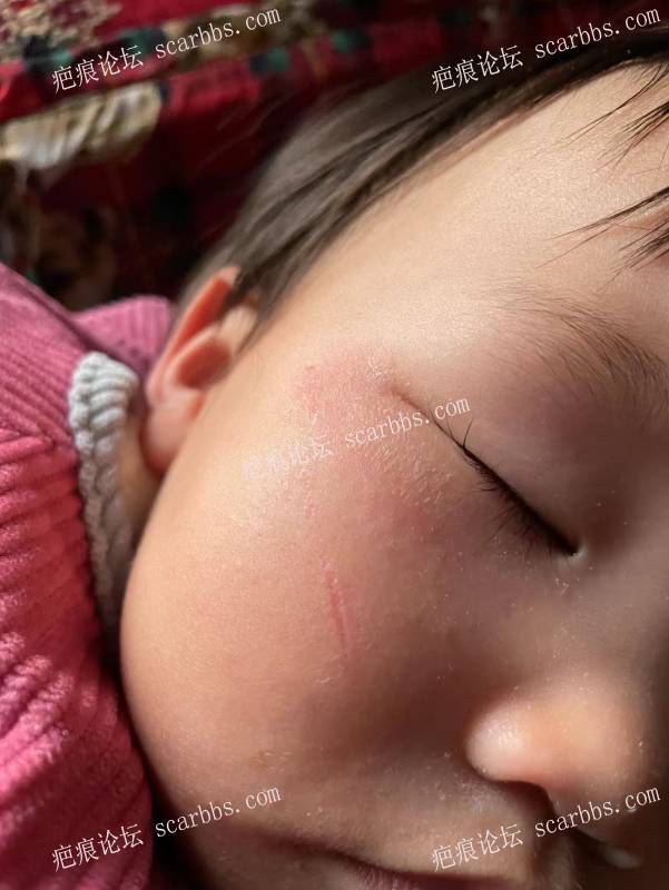 求助，小孩一岁半，被指甲划伤两个月了留有红色凹陷疤痕 