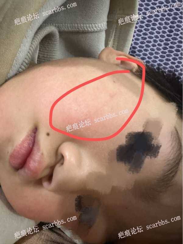 儿童脸颊划伤，怎么护理？ 