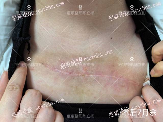 胸部疤痕疙瘩患者术后7月反馈 