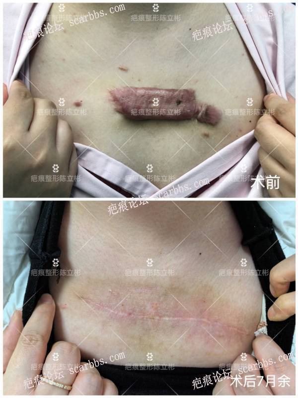 胸部疤痕疙瘩患者术后7月反馈 