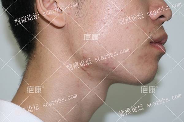 贵州刘先生双颌下4年疤痕疙瘩治疗案例 