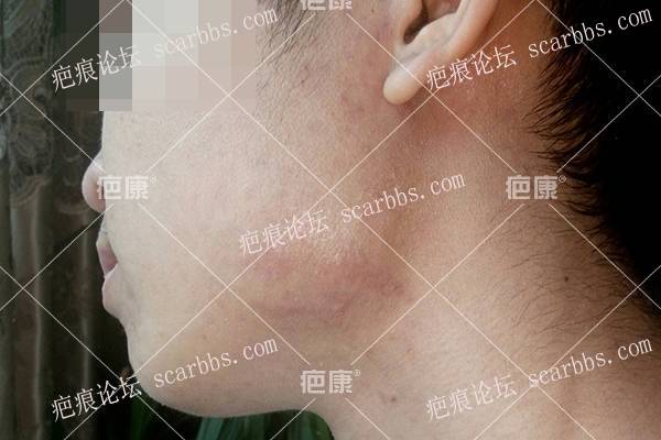 贵州刘先生双颌下4年疤痕疙瘩治疗案例 
