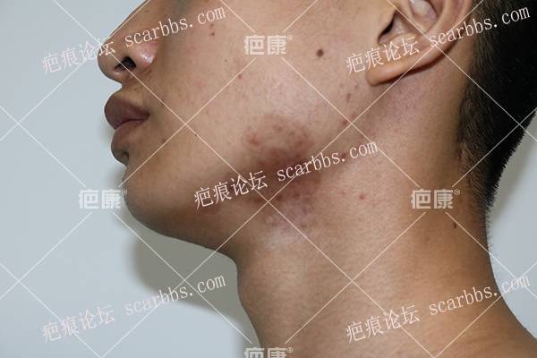 江苏林先生颌下7年疤痕疙瘩治疗案例 