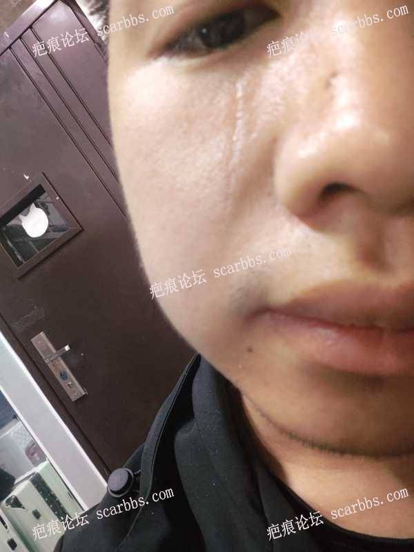 4月26日杨教授手术切除眼睛下边疤痕 
