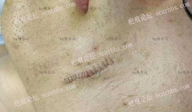 2023年4月6日在重庆东上找杨东运教授做了凹陷疤痕修复 