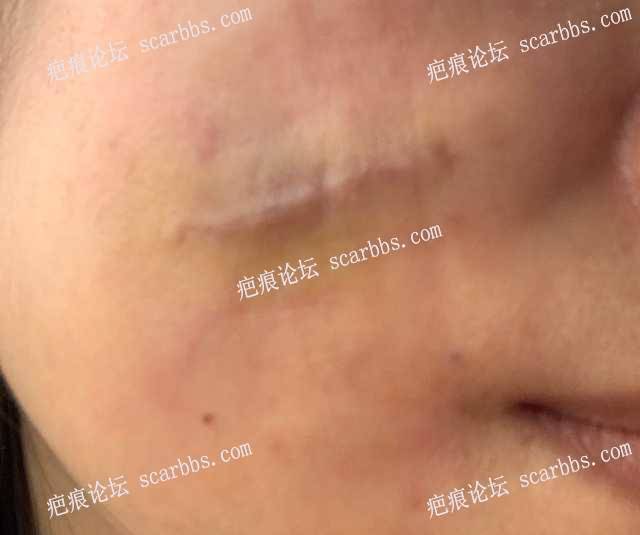 面部疤痕2月15日在杨教授那做了疤痕修复 