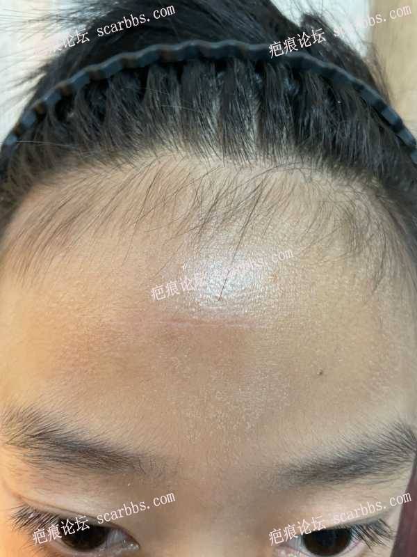 2023.7.18 十岁孩子在东上医疗汤院长额头横疤切缝治疗反馈 