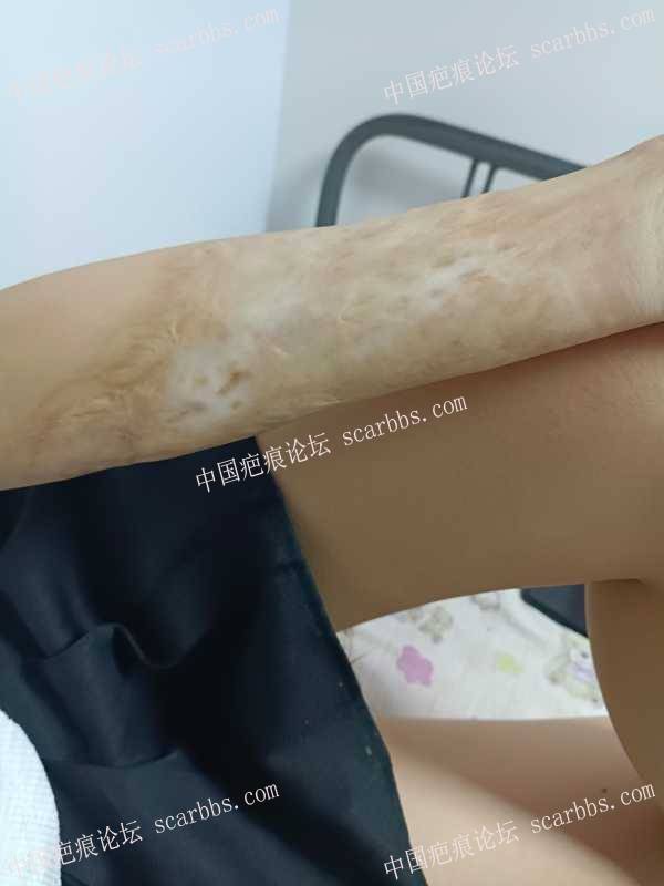 5岁烧伤疤痕，0629在杨教授处做手术+激光治疗 