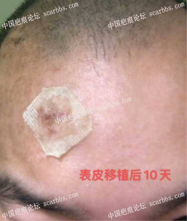 额头上疤痕，1月26日找杨教授做的手术 