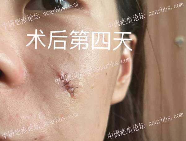 脸上疤痕在北京空总医院做的切缝，术后第4天未拆线状态，是不是毁了？ 北京空总,脸上疤痕,疤痕切除
