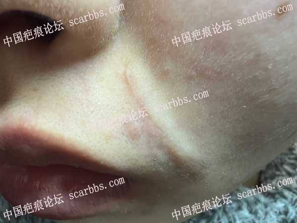 嘴唇上部嘴唇上部疤痕手术三个月，感觉有些增生 手术疤痕,增生疤痕