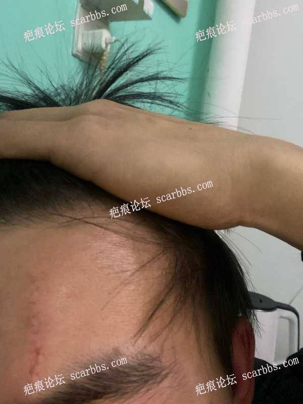 在东上医疗美容杨东运教授那做的额头疤痕修复手术 