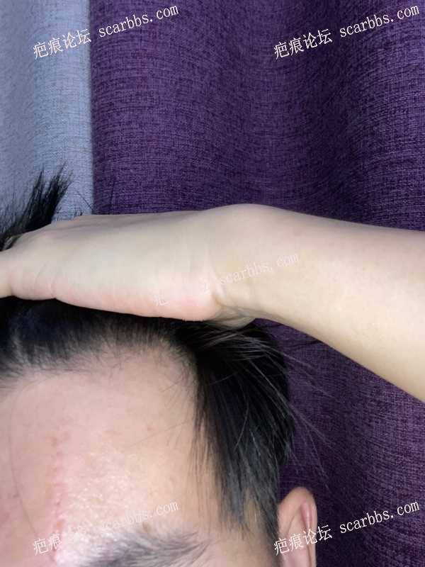 在东上医疗美容杨东运教授那做的额头疤痕修复手术 