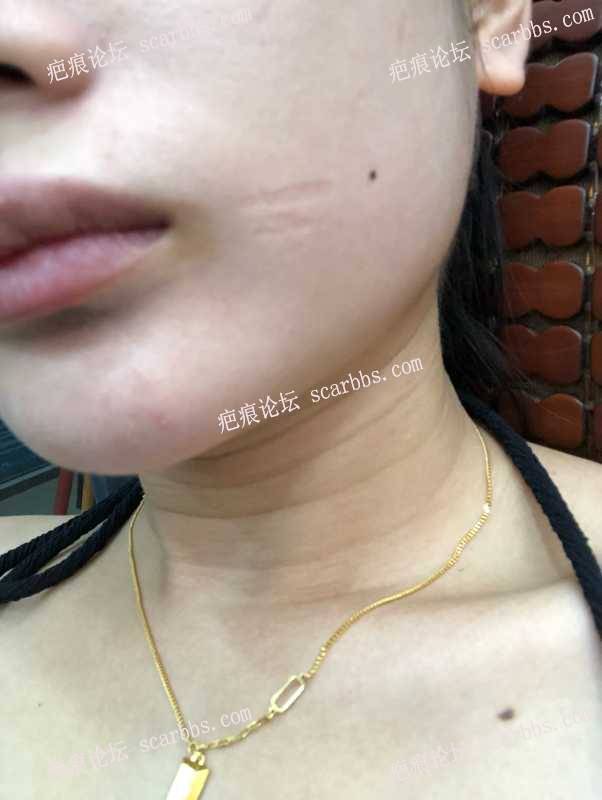 2022 10.13在杨教授做了切缝手术，右口角面部凸陷疤痕。
