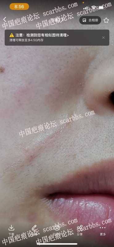 面部疤痕切缝三个月，帮我看看是猫耳朵还是增生？ 疤痕切缝,疤痕增生