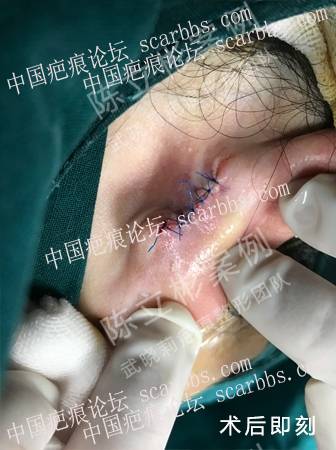 耳部疤痕疙瘩术后7个月复诊记录 耳背疤痕疙瘩,手术切除,术后放疗,加压护理