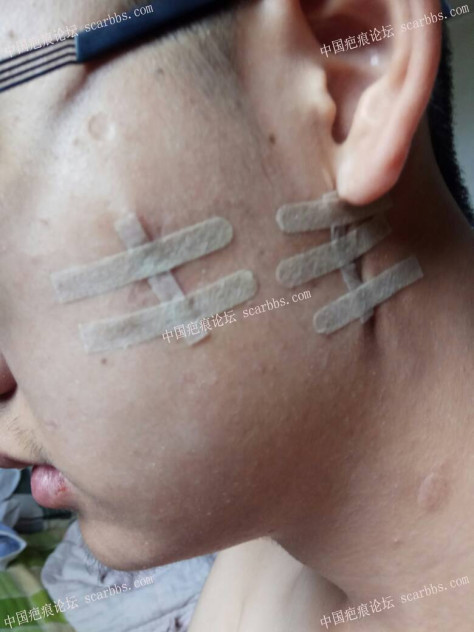 点痣留下增生疤痕，4月12日杨东运教授手术切除 