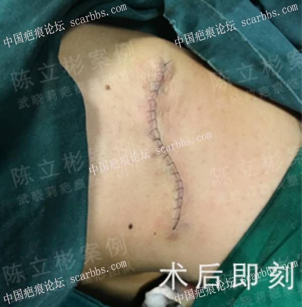 双肩背疤痕疙瘩术后14个月复诊 双肩疤痕疙瘩,背部疤痕疙瘩,手术放疗