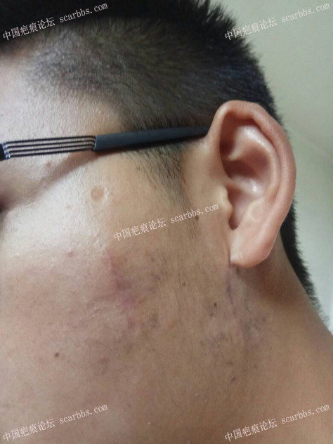点痣留下增生疤痕，4月12日杨东运教授手术切除 