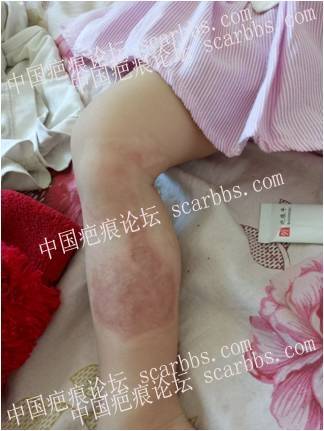6岁儿童腿部深II度烫伤疤痕平案例分享 儿童烫伤,腿部烫伤,色素沉着,联合疗法