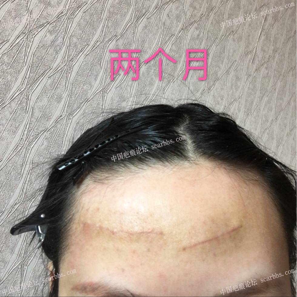 1月31号的额头疤痕切除术 额头疤痕,手术切缝,杨东运教授