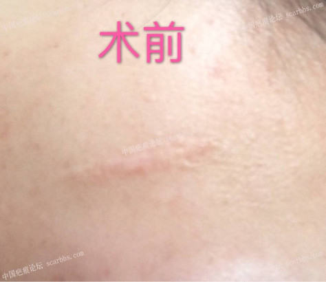 1月31号的额头疤痕切除术 额头疤痕,手术切缝,杨东运教授