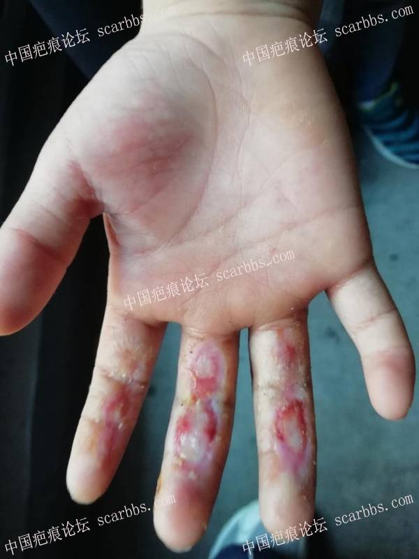 李高令2018年接治跑步机伤到手的孩子(常州) 