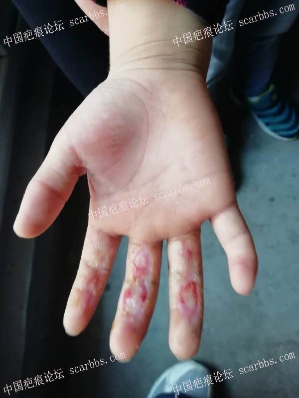 李高令2018年接治跑步机伤到手的孩子(常州) 