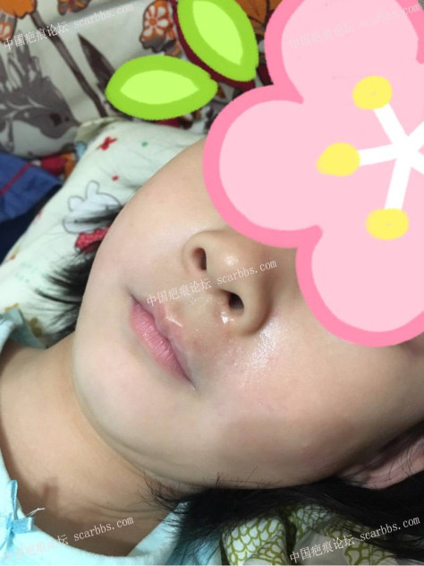 宝贝嘴巴摔伤，分享手术和护理过程。 