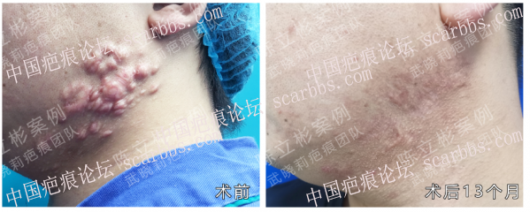 下颌疤痕疙瘩术后1年复诊记录 下颌疤痕疙瘩,减张精细缝合,放疗