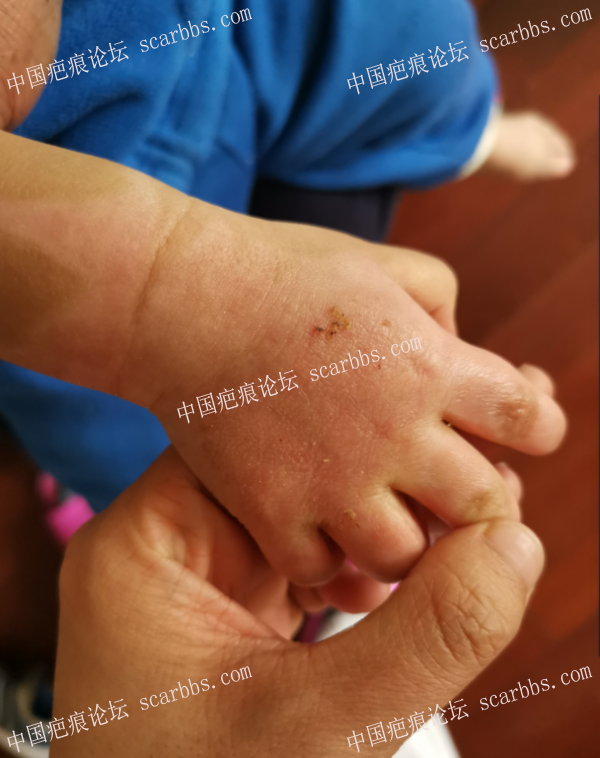 李高令2019年接治第七个受伤孩子(北京) 