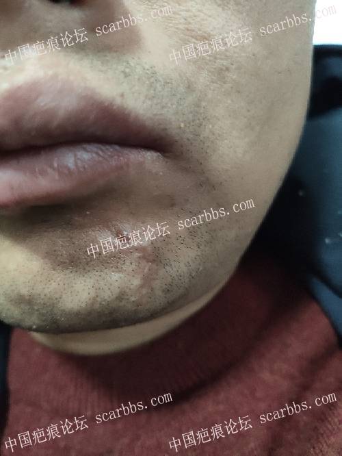 下巴处凹陷疤痕，2018年12月6号找杨教授切缝 凹陷疤痕,下巴,杨东运教授