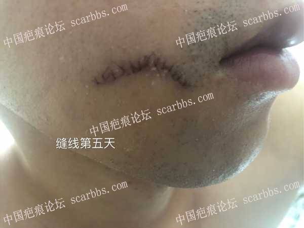 面部凹陷疤痕，广州中山三院（胡瑛）做的疤痕切缝手术 凹陷疤痕,切缝