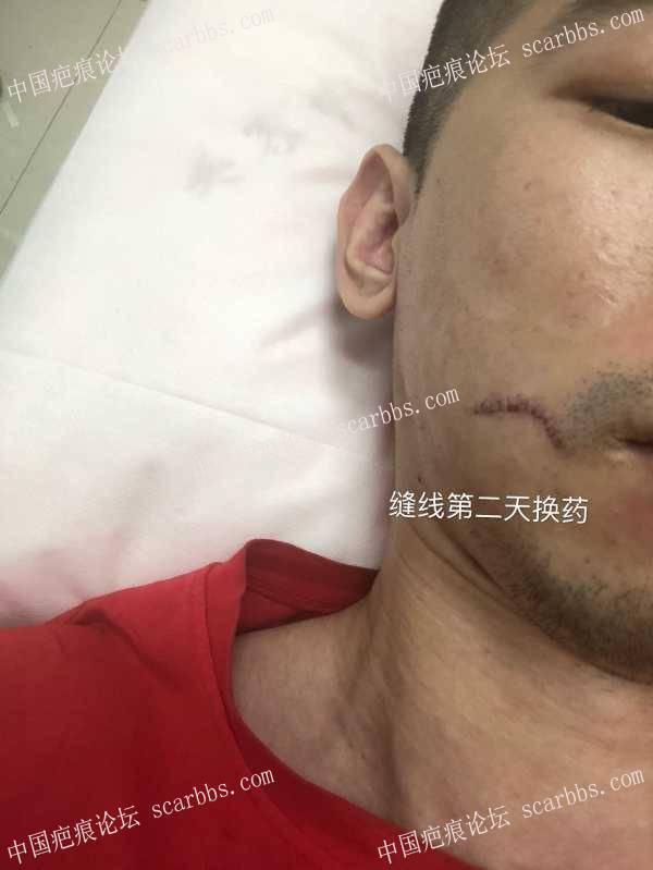 面部凹陷疤痕，广州中山三院（胡瑛）做的疤痕切缝手术 凹陷疤痕,切缝