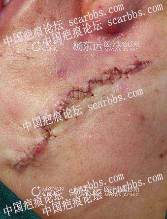 2019-11-11杨教授脸部疤痕切缝贴 面部陈旧性疤痕,手术切缝