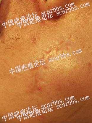 2019-11-11杨教授脸部疤痕切缝贴 面部陈旧性疤痕,手术切缝